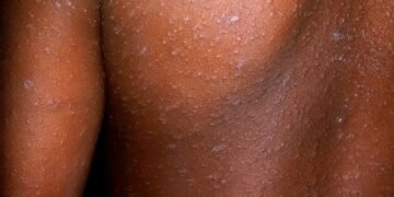 Obulwadde bwa mulangira bubaluseewo mu district ye Mityana